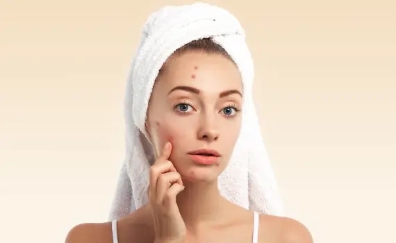 Acne Scar Treatment