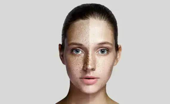 Pigmentation Treatment in Delhi