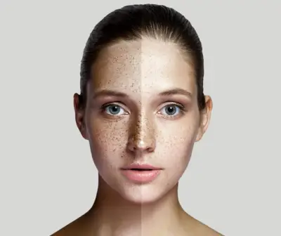 Pigmentation Treatment in Delhi