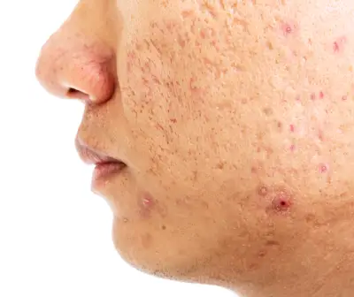 Acne Scar Treatment in Delhi