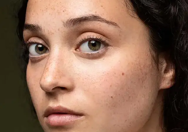 What are the different types of melasma?