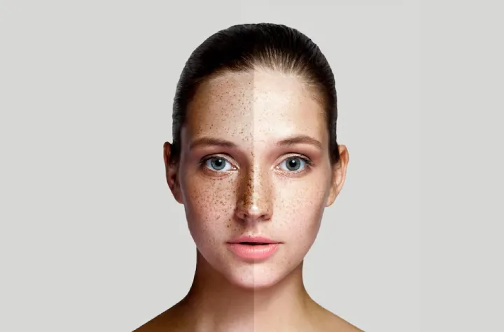 Pigmentation Treatment in Delhi