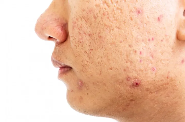 Acne Scar Treatment in Delhi