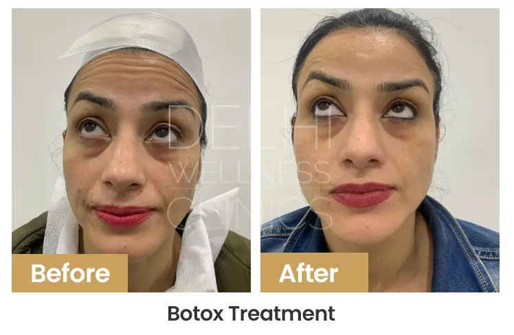 Botox Treatment