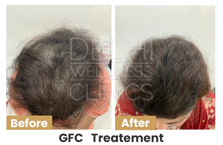 GFC Treatment